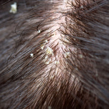 Load image into Gallery viewer, Seborrheic Dematitis Hair Oil 2 oz, Scalp Relief, Eczema, Psoriasis, Scaling,  Itching and flaking