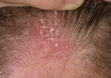 Load image into Gallery viewer, Seborrheic Dematitis Hair Oil 2 oz, Scalp Relief, Eczema, Psoriasis, Scaling,  Itching and flaking