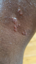 Load image into Gallery viewer, ECZEMA & DERMATITIS TREATMENT 4 oz, Psoriasis, Treats Acne, Rosacea, Pet Rashes, Pet hot spots
