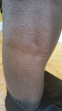 Load image into Gallery viewer, ECZEMA & DERMATITIS TREATMENT 4 oz, Psoriasis, Treats Acne, Rosacea, Pet Rashes, Pet hot spots