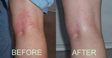Load image into Gallery viewer, ECZEMA & DERMATITIS TREATMENT 4 oz, Psoriasis, Treats Acne, Rosacea, Pet Rashes, Pet hot spots