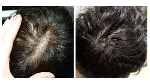 Hair Growth Oil InfinityDHT, Alopecia, Thinning Hair, Balding, Organic