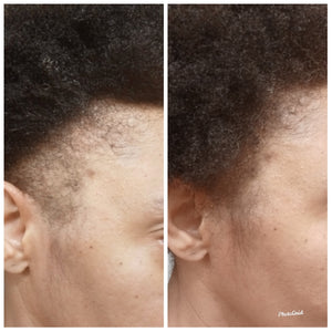 Hair Growth Oil InfinityDHT, Alopecia, Thinning Hair, Balding, Organic